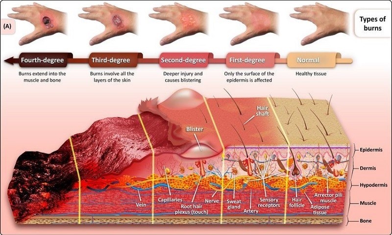 Degree of Burns